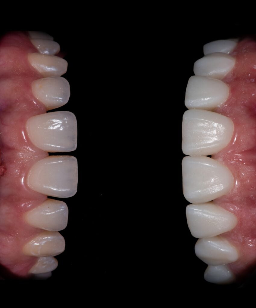 Comparison of teeth with and without veneers - Porcelain Veneers in St. George, UT Comparison of teeth with and without veneers - Porcelain Veneers in St. George, UT